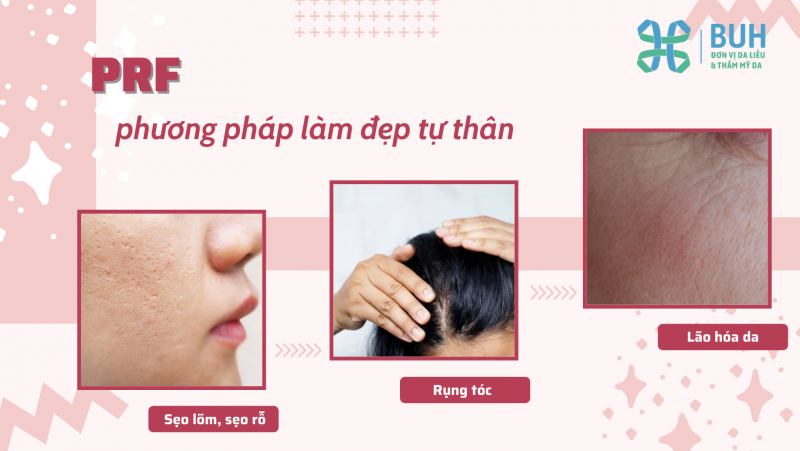 làm đẹp tự thân bằng prf