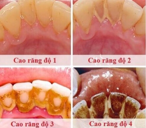 7. Cách chăm sóc răng sau khi cạo vôi