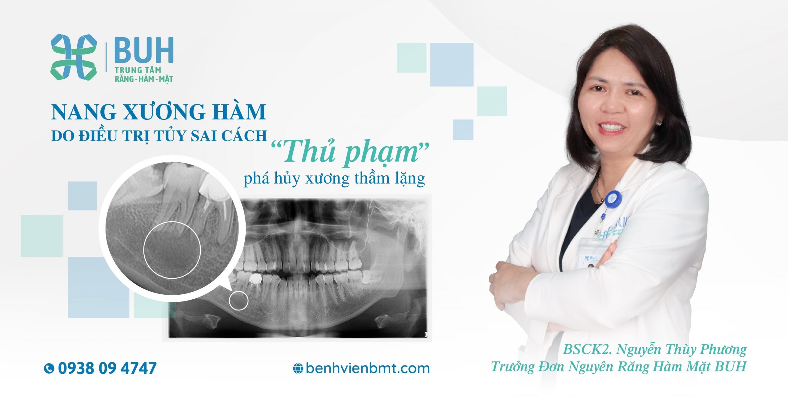 Có cách nào để ngăn ngừa u nang xương hàm không?