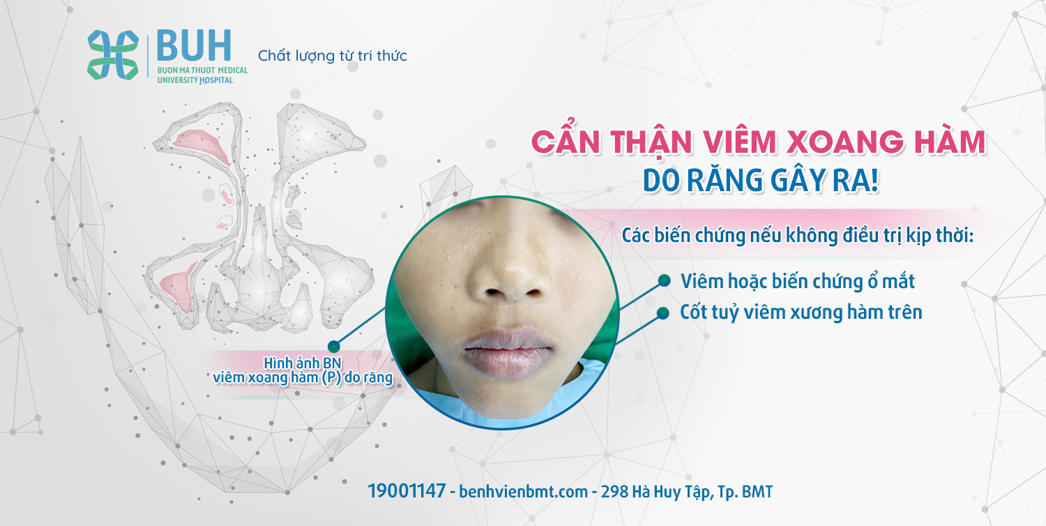 BUH PHẪU THUẬT NỘI SOI ĐIỀU TRỊ VIÊM XOANG HÀM DO RĂNG - BUH