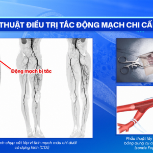 PHẪU THUẬT ĐIỀU TRỊ TẮC ĐỘNG MẠCH CHI CẤP TÍNH