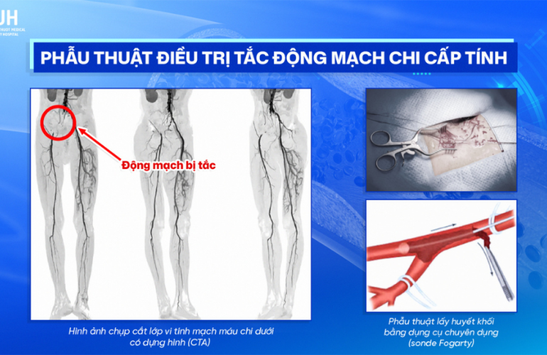 PHẪU THUẬT ĐIỀU TRỊ TẮC ĐỘNG MẠCH CHI CẤP TÍNH