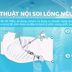 PHẪU THUẬT NỘI SOI LỒNG NGỰC (VATS) CẮT BỎ THÀNH CÔNG KHỐI U BAO THẦN KINH KÍCH THƯỚC LỚN