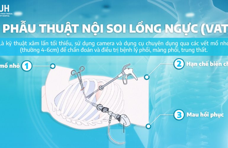 PHẪU THUẬT NỘI SOI LỒNG NGỰC (VATS) CẮT BỎ THÀNH CÔNG KHỐI U BAO THẦN KINH KÍCH THƯỚC LỚN
