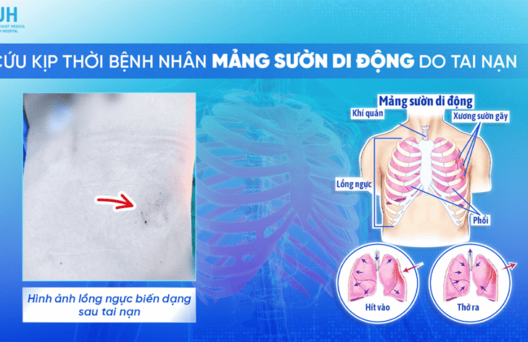 Cấp cứu kịp thời bệnh nhân mảng sườn di động do tai nạn