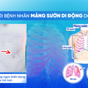 Cấp cứu kịp thời bệnh nhân mảng sườn di động do tai nạn