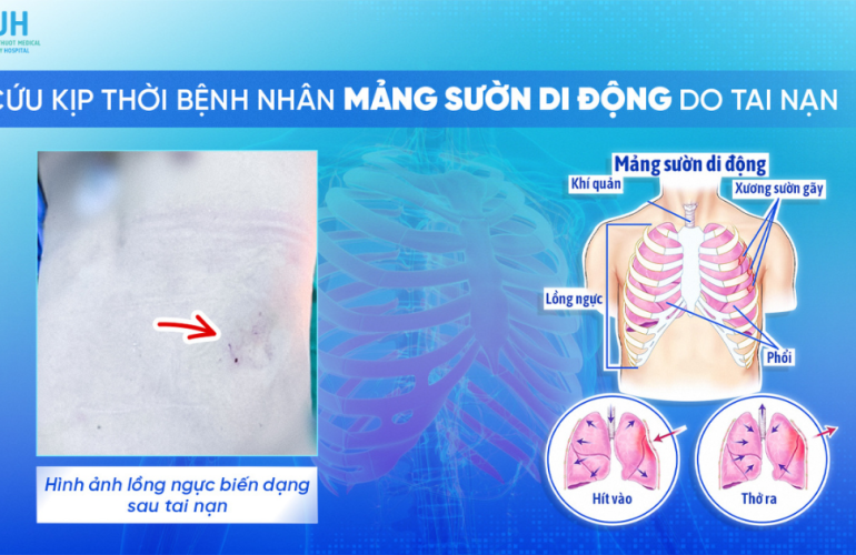 Cấp cứu kịp thời bệnh nhân mảng sườn di động do tai nạn