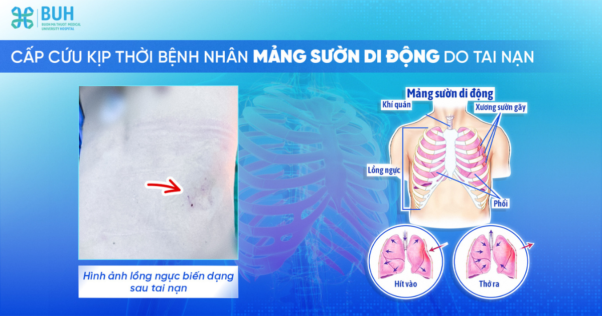 Cấp cứu kịp thời bệnh nhân mảng sườn di động do tai nạn BUH