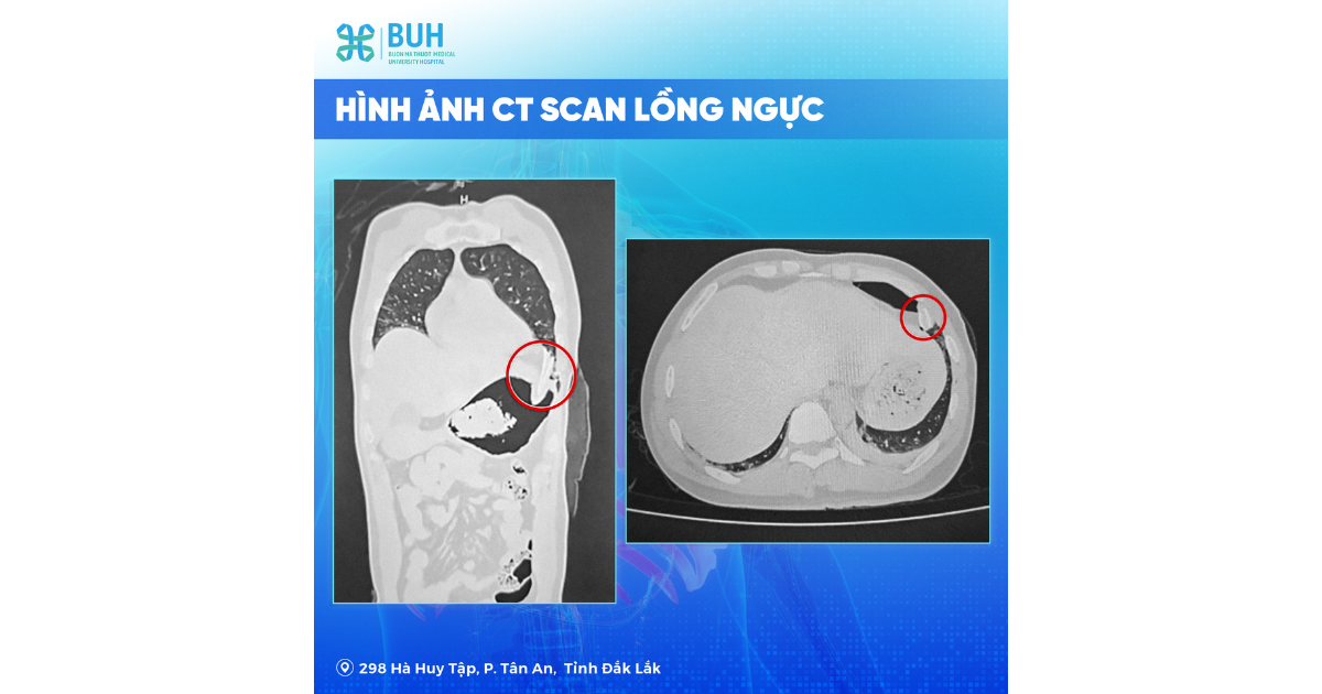Hình ảnh lồng ngực biến dạng sau tai nạn BUH