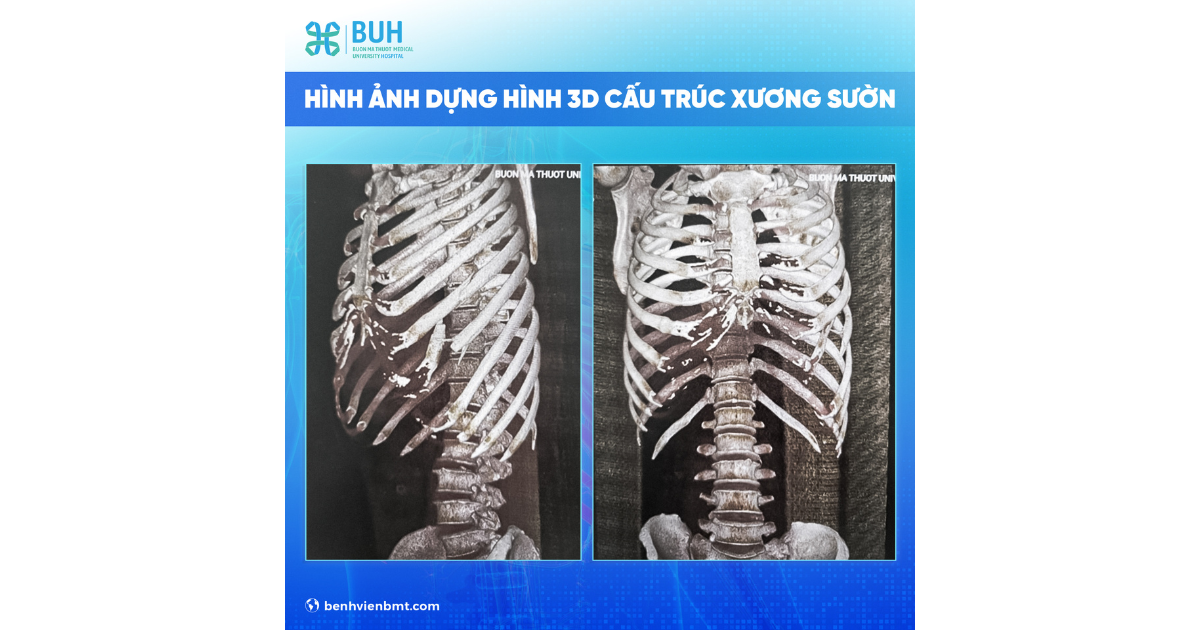 Hình ảnh CT scan lồng ngực và dựng hình 3D cấu trúc xương sườn 