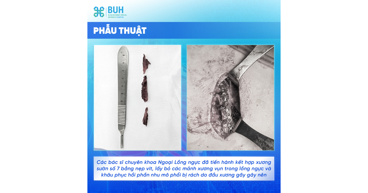 Hình ảnh kết hợp xương sườn số 7 bằng nẹp vít BUH
