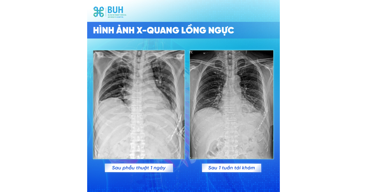 X-quang ngực sau phẫu thuật 1 ngày BUH