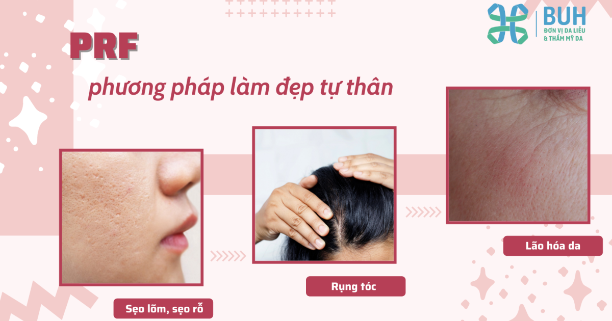làm đẹp tự thân bằng prf