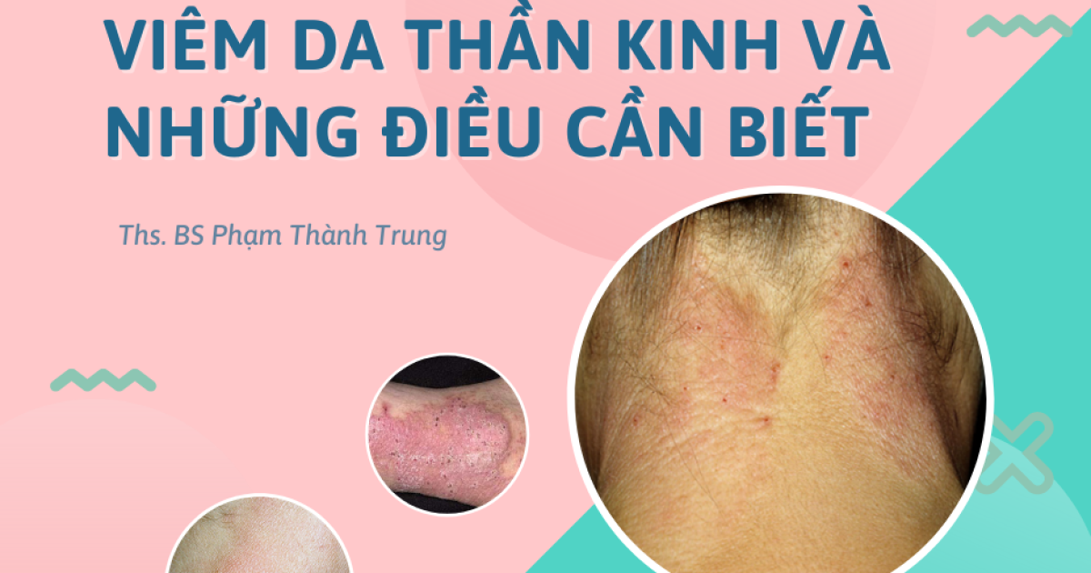 viêm da thần kinh