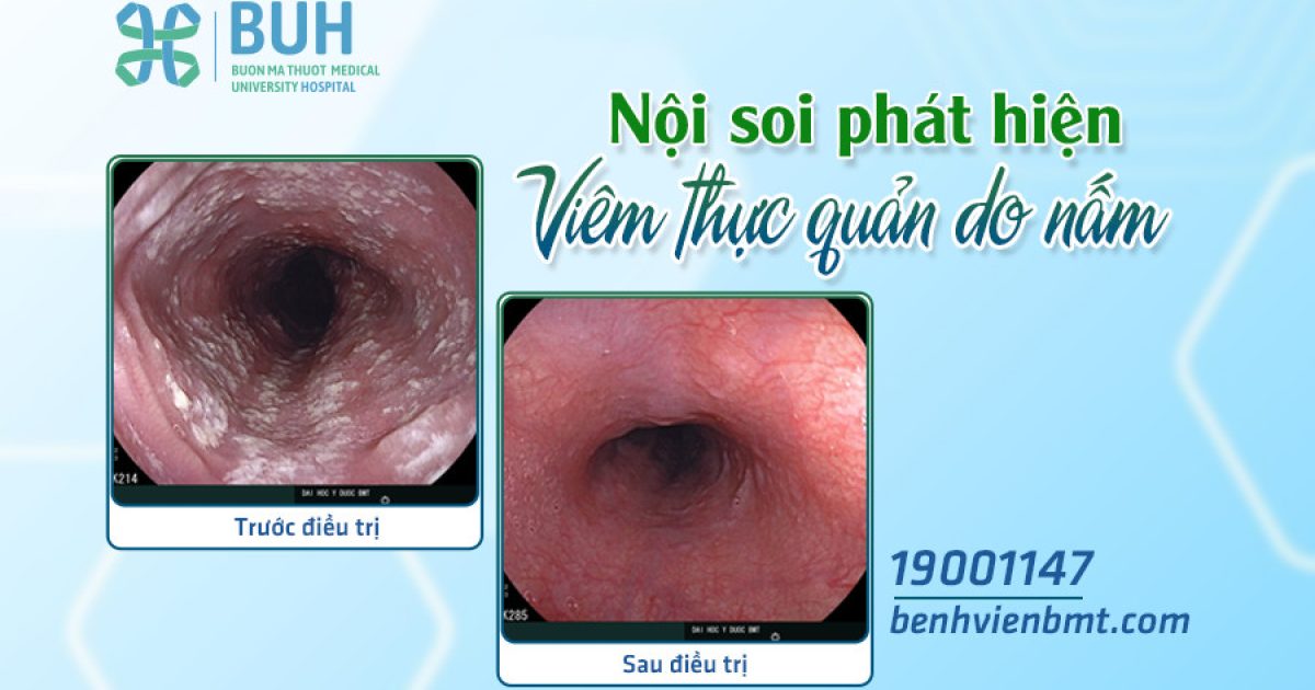 VIÊM